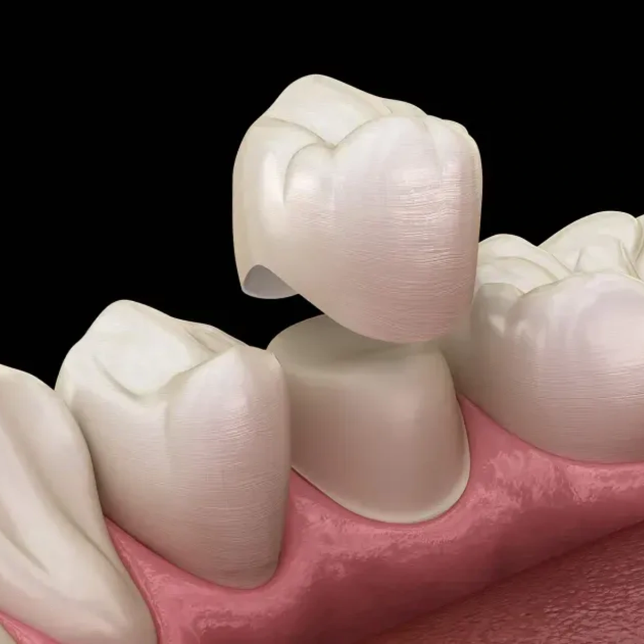 Dental Crowns