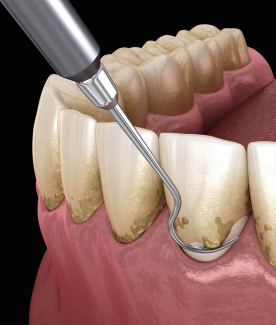 Non-Surgical Gum therapy