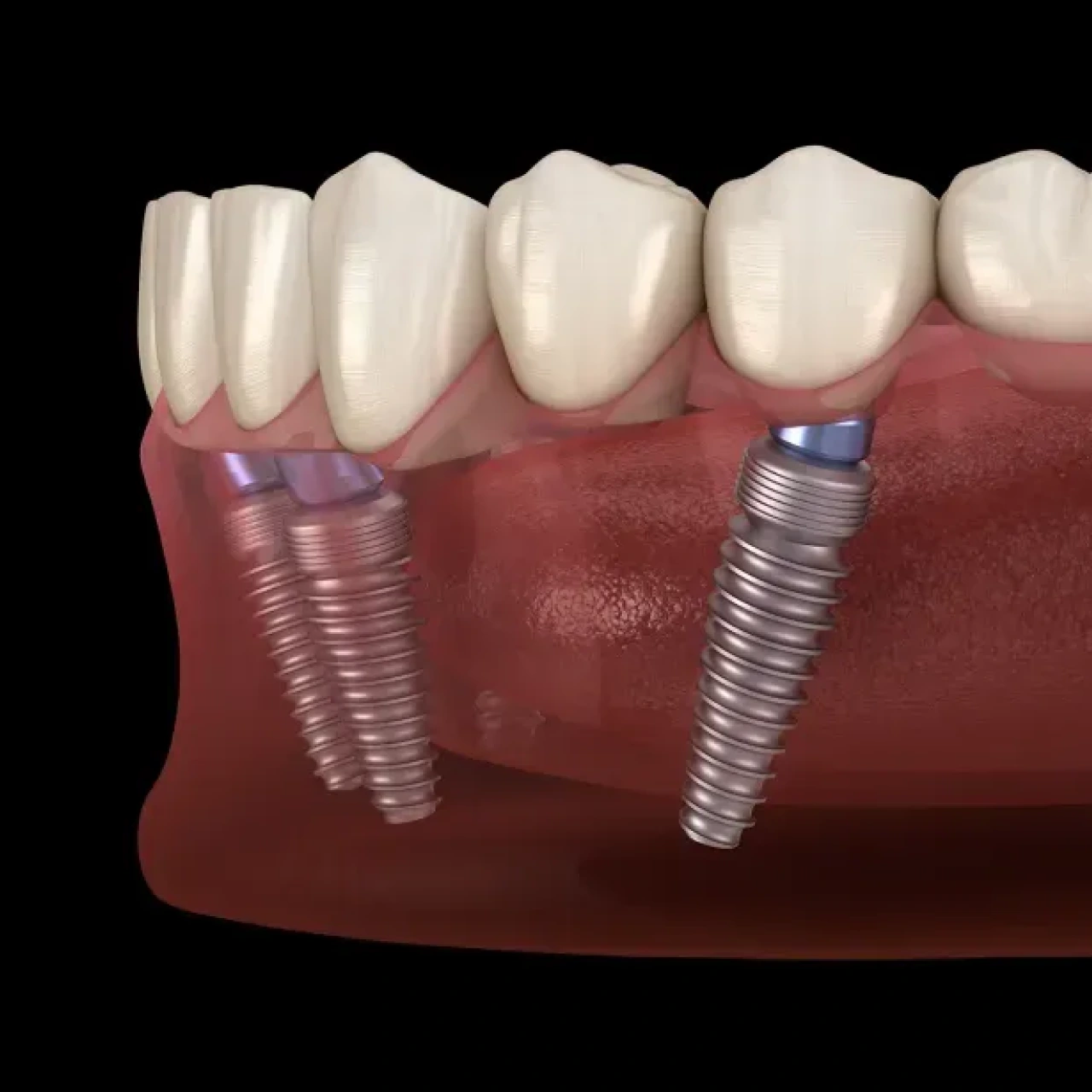 Implants for Multiple
Missing Teeth