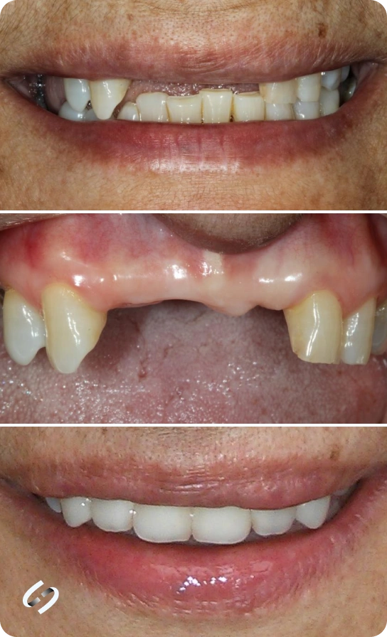 Smile makeover before and after image