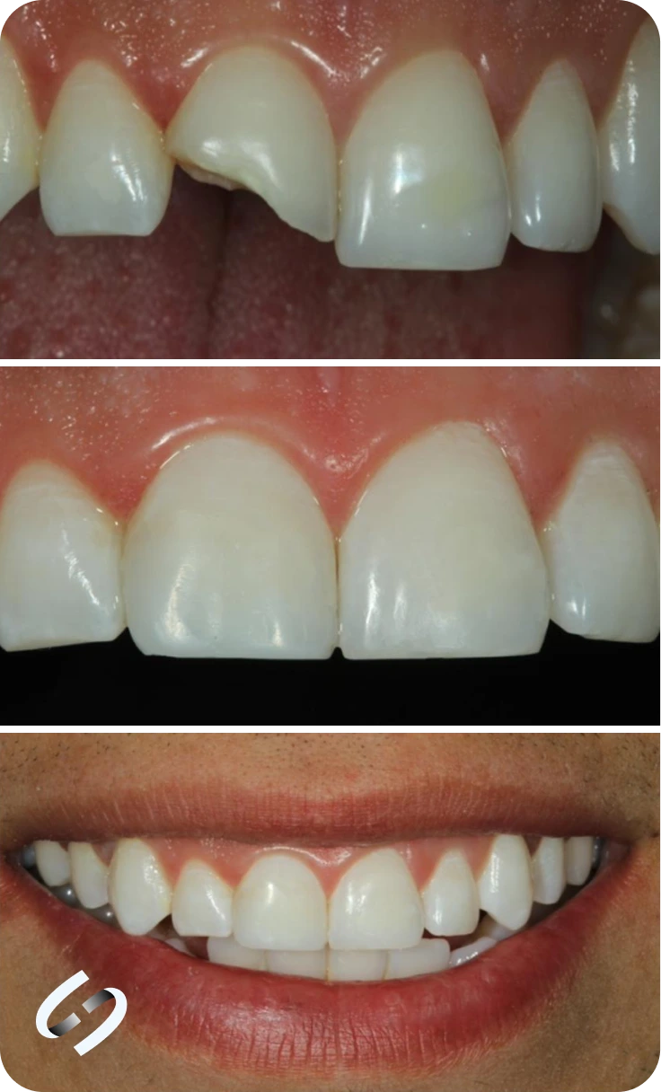 Smile makeover before and after image