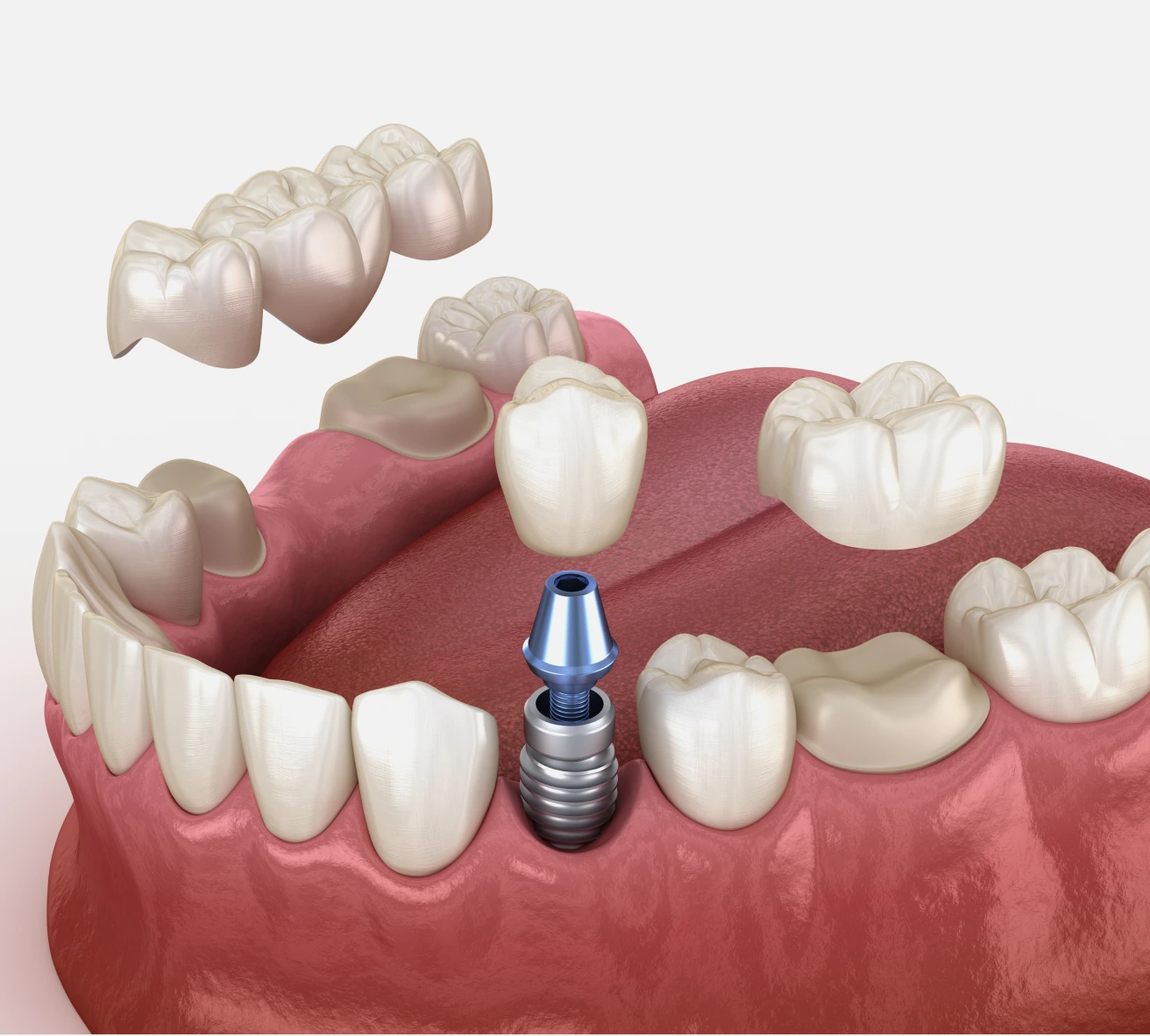 Dental Implants