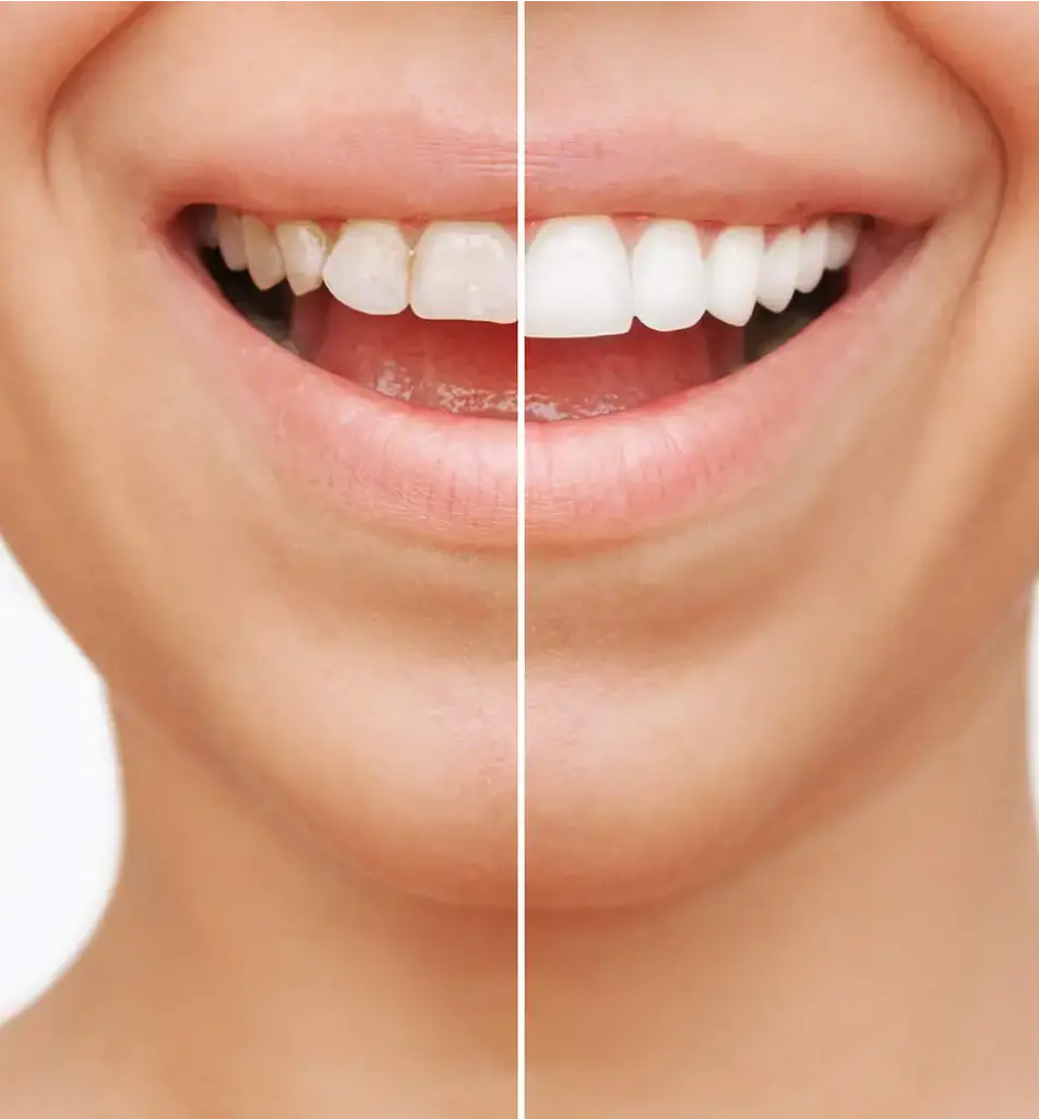 Dental Veneers
