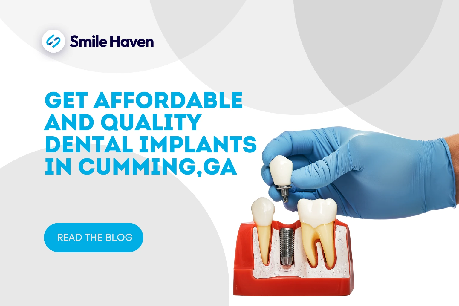 Get Affordable and quality Dental Implants in Cumming, GA