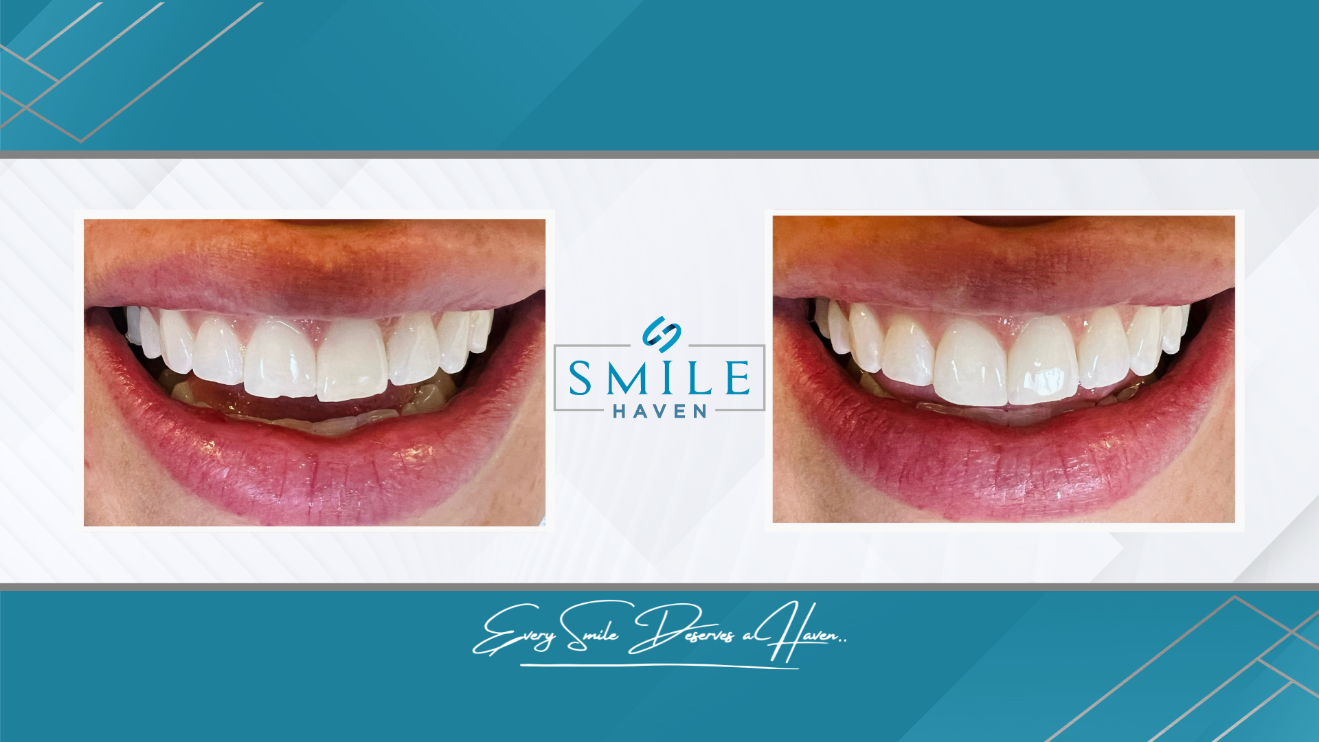 Tooth colored restoration